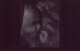 3d Ultrasound