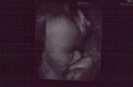 3d Ultrasound