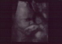 3d Ultrasound