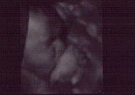 3d Ultrasound