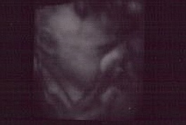 3d Ultrasound