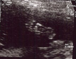 Foot Ultrasound