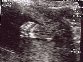 Foot Ultrasound