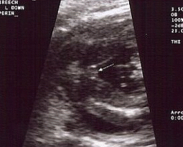 Girl Ultrasound